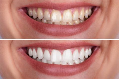 The Science Behind the Magic: How Teeth Whitening Works